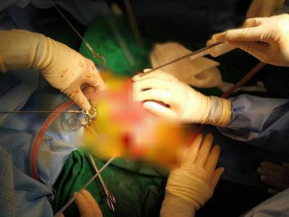 Kịp thời cứu sống bé gái hơn 1 tuổi bị mảnh cốc cắm thủng bụng